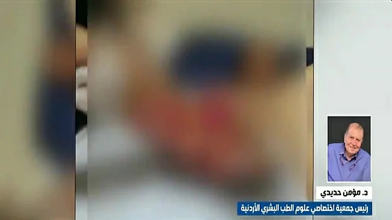 مختص أردني: من حق المواطن السعودي المتعرض للحروق أن يصطحب أفضل أطباء الطب الشرعي "فيديو"