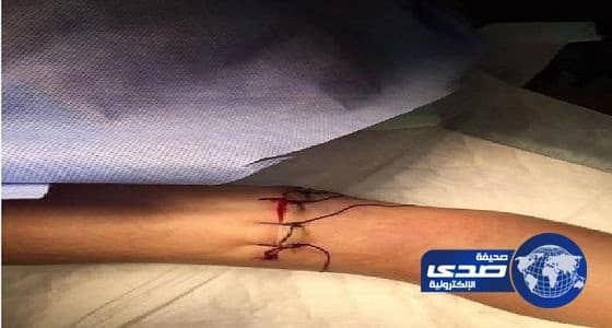 إنهاء معاناة عشريني من التهاب الجيوب الأنفية الفطرية التحسسي بمدينة الملك عبدالله الطبية