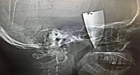 جراحة ناجحة لشاب مصاب في وجهه بمجمع الملك فيصل بالطائف