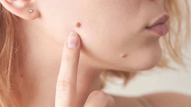 بالفيديو .. استشاري: الشامات قد تتحول إلى أمراض سرطانية