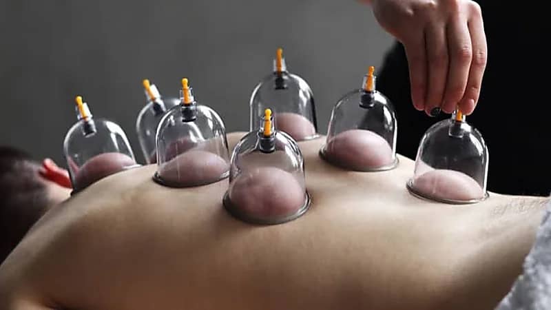 استخدامات طبية للحجامة: بين الوقاية والعلاج وفق أبحاث محلية.. فيديو