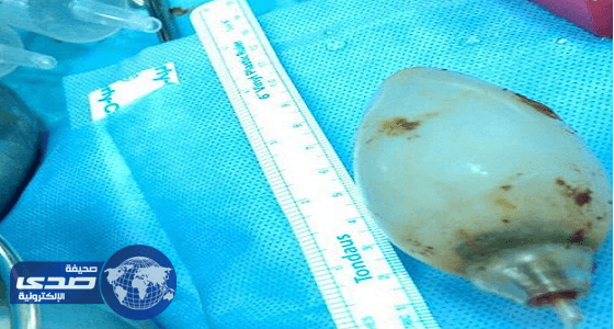 إستخراج لمبة كهربائية من بطن عامل ابتلعها منذ 11 عام