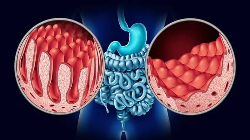 أبرز أعراض مرض "السيلياك" المناعي
