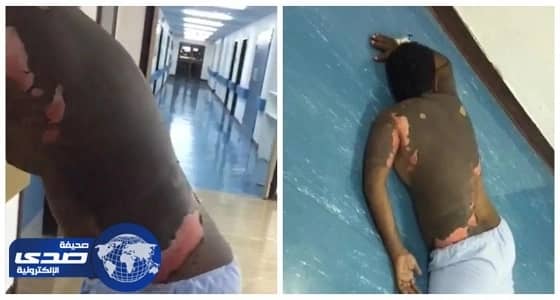 القبض على السيدة حارقة زوجها بالزيت المغلي