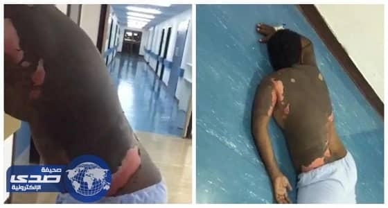 صحة بيشة تكشف تفاصيل فيديو حرق مواطن