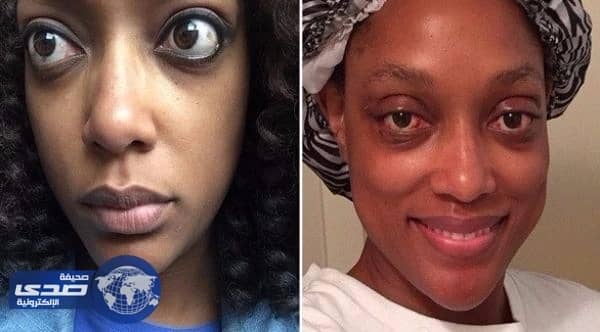 عملية جراحية لأمريكية لإعادة عينيها لمكانهما