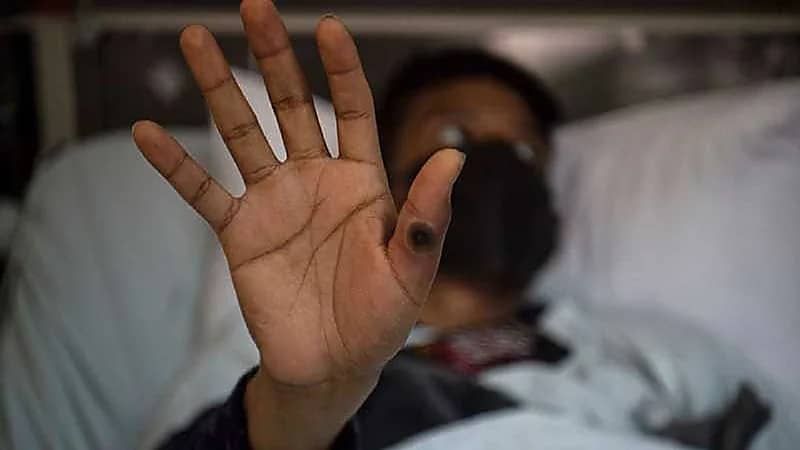 الصحة العالمية تعلن انتهاء حالة الطوارئ الصحية العامة لجدري القردة