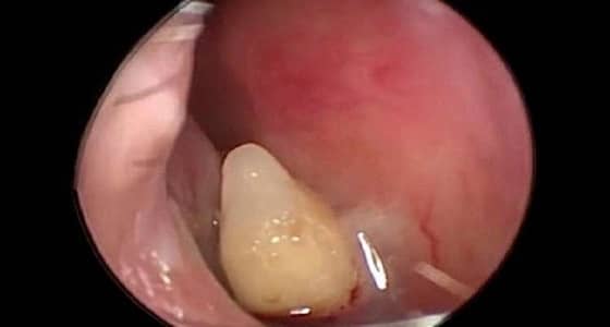 خلع سن في أنف سيدة صينية