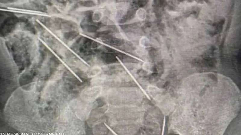 طفل يبتلع 8 إبر حقن مخصصة للحيوانات