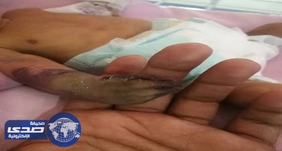 بتر كف رضيع جازان بأحد المستشفيات الخاصة بعسير