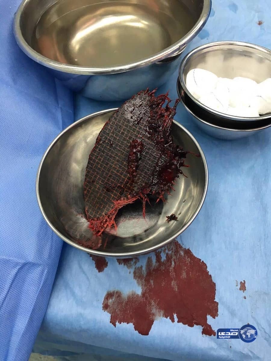 "سعود الطبية" استقبلت ٥ آلاف "مصاباً" خلال شهرين!