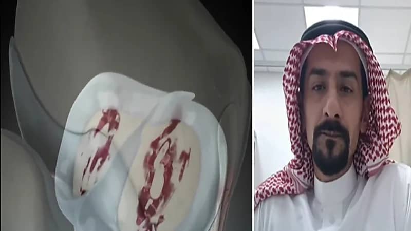 استشاري: استبدال مفاصل الركبة من أنجح العمليات في تاريخ الجراحة(فيديو)