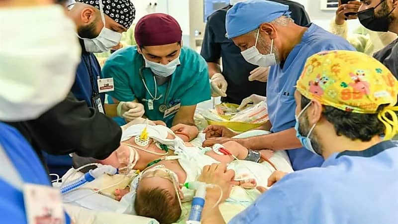 بالفيديو.. "الربيعة" يعلن نجاح عملية فصل التوأم السيامي اليمني