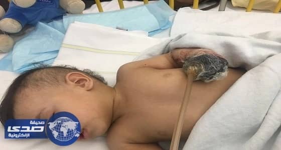 إجراء جراحة لزراعة «كف» الرضيع «جسار» أسفل معدته