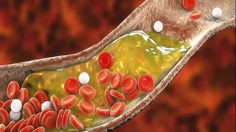 أعراض ارتفاع الكوليسترول في الدم