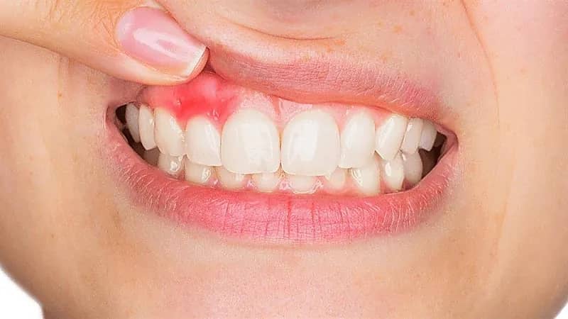 باحثون: أمراض اللثة تسبب العقم للمرأة
