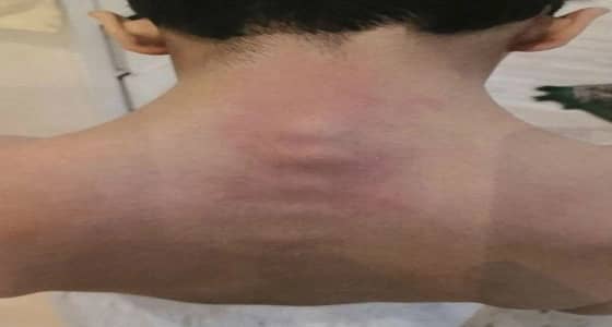 تعليم عسير يكشف حقيقة اعتداء معلم على طالب وتسببه في انزلاق فقراته