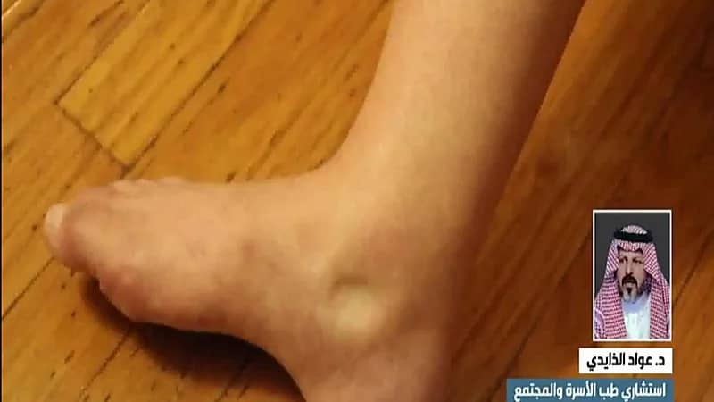 استشاري: ارتفاع ضغط الدم أحد أسباب تورم الجسم والنساء الحوامل أكثر عرضة للإصابة (فيديو)