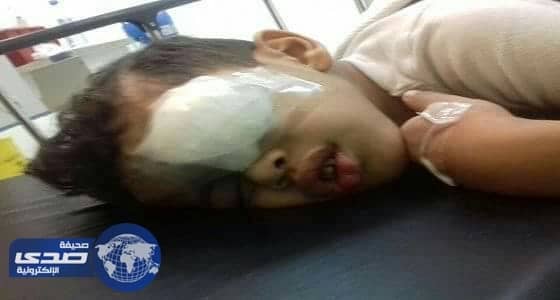 انفجار لعبة نارية تلحق ضرر بالغ بعين طفل