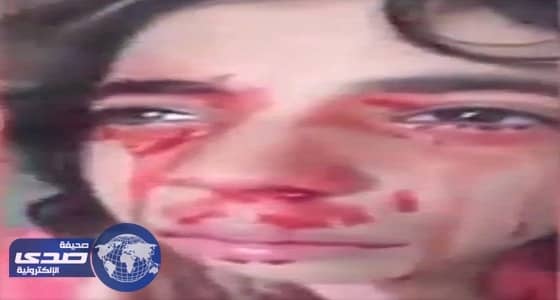 بالفيديو.. " آية " طفلة تنزف دما من كل جسدها