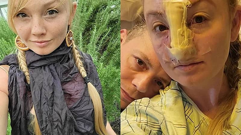 كلب بيتبول ينهش أنف صاحبته