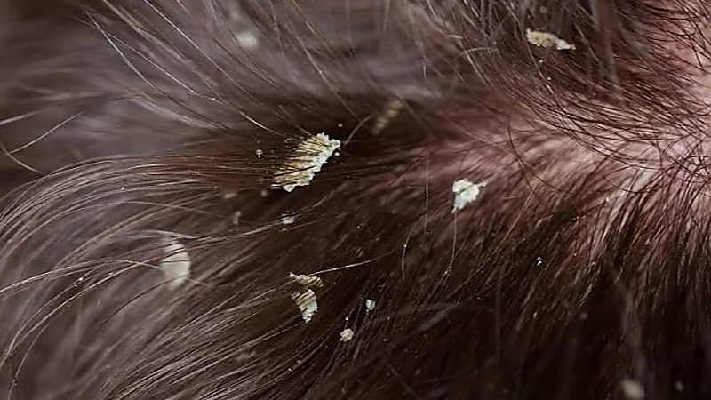 طريقة مدهشة للتخلص من قشرة الشعر نهائيًا