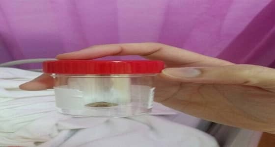 لأول مرة.. إزالة حصوة حالب بتقنية المناظير بمجمع الدمام