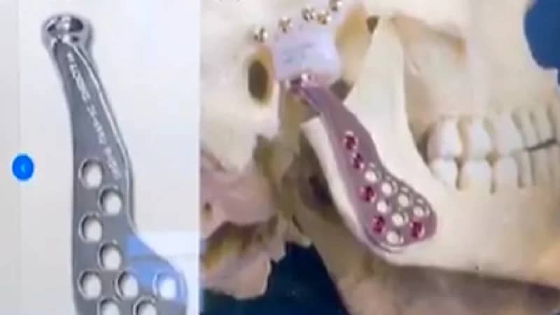 بالفيديو.. فريق طبي بالخبر ينجح في إزالة التحام حاد بين الجمجمة والفك لمريضة