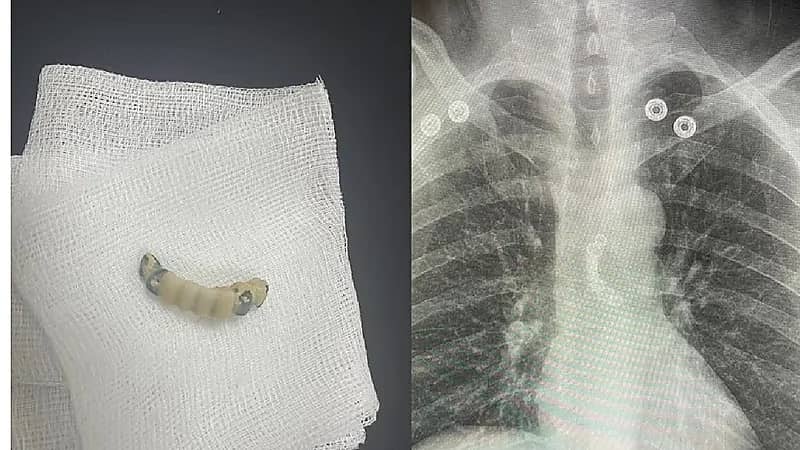 استخراج طقم أسنان من مرئ سبعيني ابتلعه بالخطأ بالمدينة