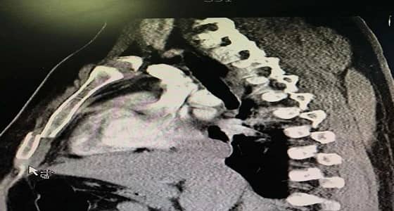 نجاح أول عملية تثبيت للقفص الصدري بمستشفى الملك فهد في الباحة