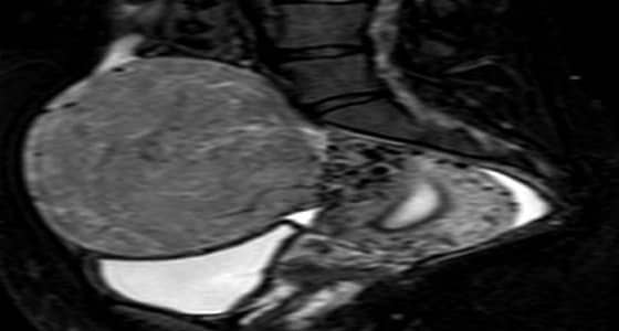 إحياء أمل سيدة في الانجاب بعد الحفاظ على رحمها بالمدينة المنورة