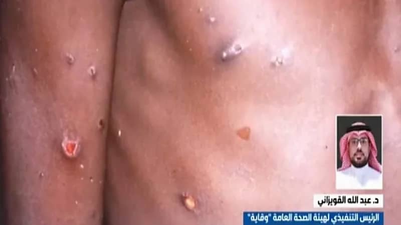 شاهد.. وقاية توضح ما يجب فعله حال الاحتكاك بشخص مصاب بجدري القردة