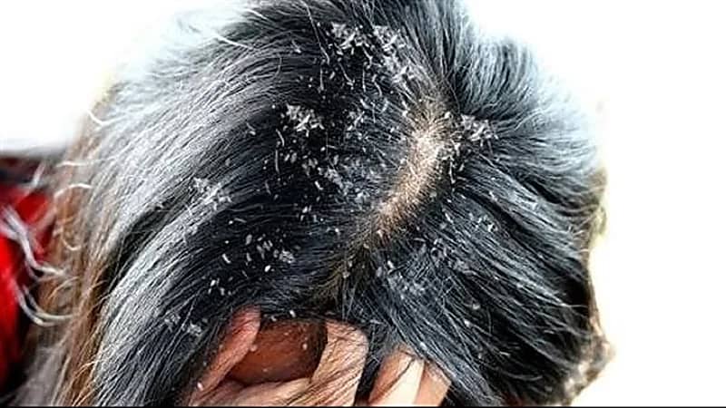 طريقة سهلة  للتخلص من قشرة الرأس