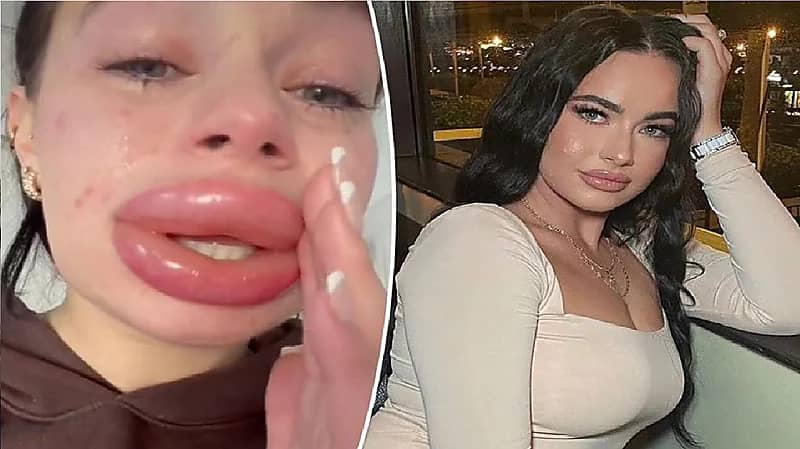 نتيجة كارثية لفتاة استجابت لعرض مجاني لنفخ الشفاه عبر الإنترنت