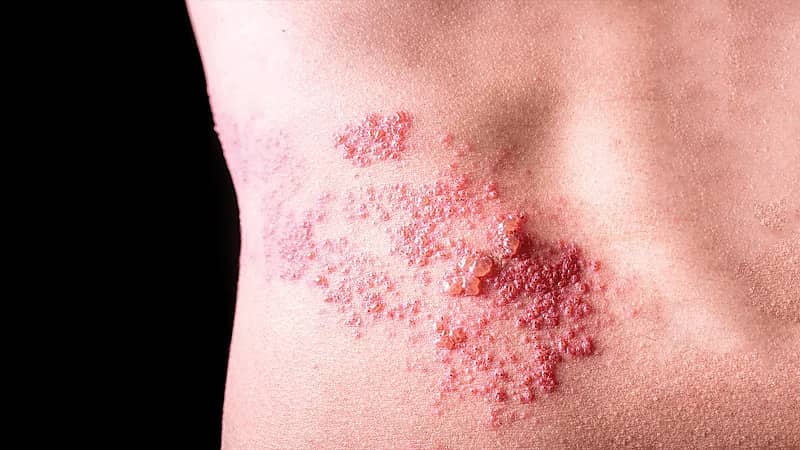 طبيب : الحزام الناري قد يسبب العمى .. فيديو