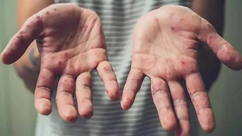 إعلان حالة طوارئ صحية عالمية بعد تفشي فيروس "جدري القردة"