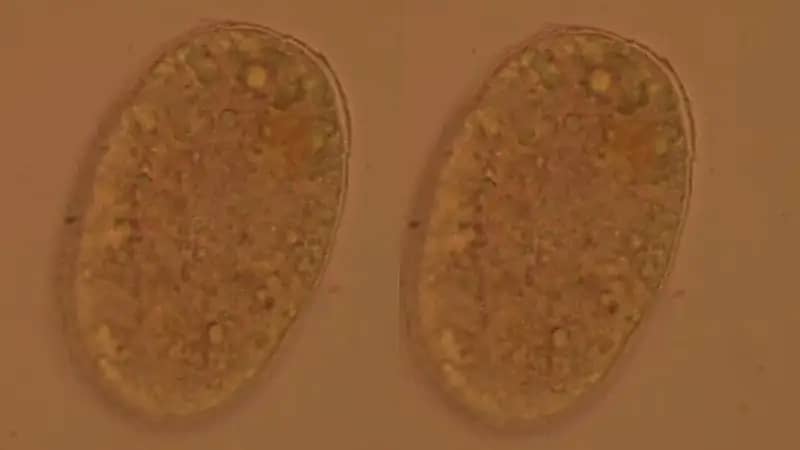 ‎أطباء يكتشفون ديدانًا مماصةً للدماء في أمعاء امرأة