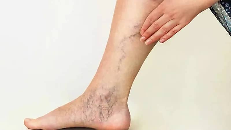 برودة الأطراف قد تكون إنذارًا مبكرًا للإصابة بالدوالي