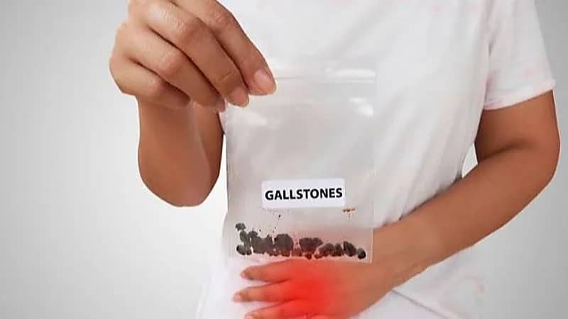 5 علاجات طبيعية فعالة لحصوات الكلى صغيرة الحجم