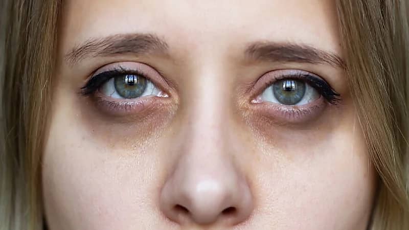 نصائح للتخلص من السواد تحت العين