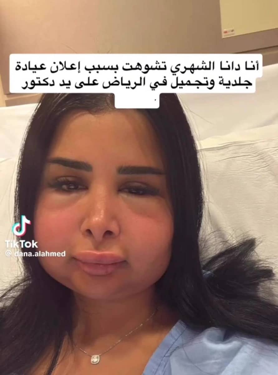 تشوه وجه دانة الشهري نتيجة عملية تجميل فاشلة غيّرت ملامحها بالكامل