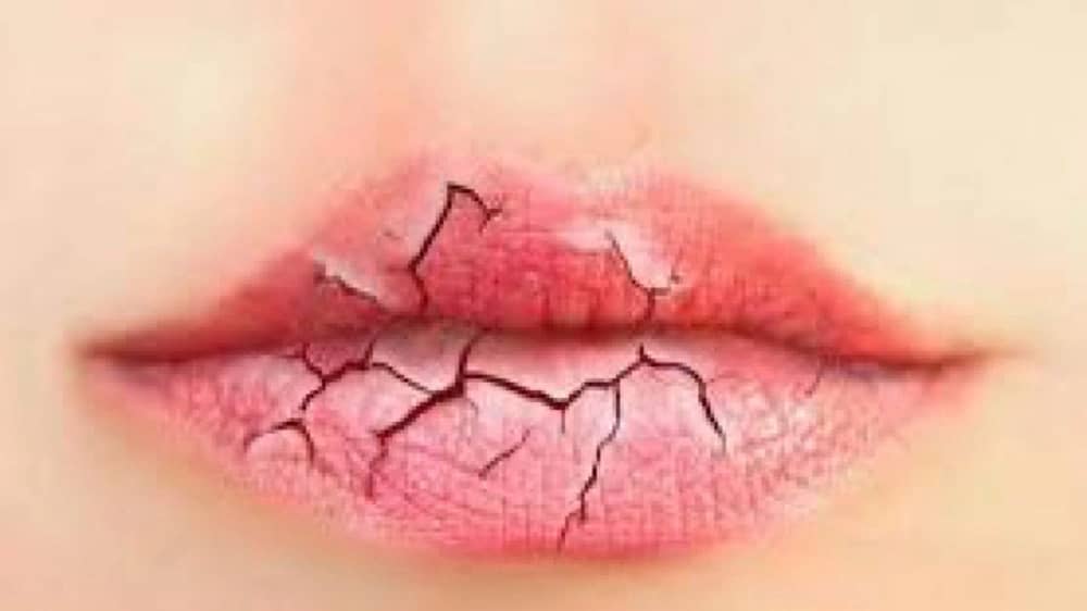 أسباب تشقق الشفاة وطرق الوقاية والعلاج