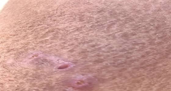 مقيم يتعرض للهجوم من 4 كلاب ضالة بمهد الذهب