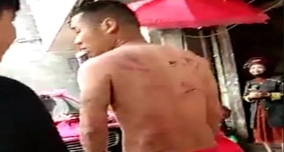 جلد عريس ورش الملح على جروحه عادة قديمة كادت تشوه ظهره