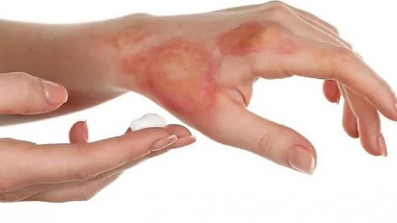 "علماء" يبتكرون بوليمير لعلاج الحروق تنمو عليه الخلايا بسرعة