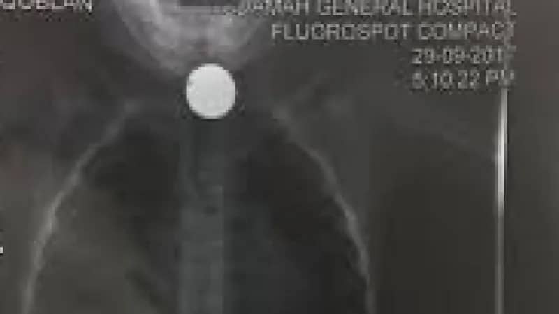 انقاذ حياة طفل ابتلع بطارية و14 قطعة لأجسام مختلفة توقفت بالمريء في نجران