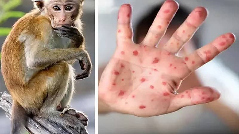 مصر تعلن عن أول إصابة بجدري القردة