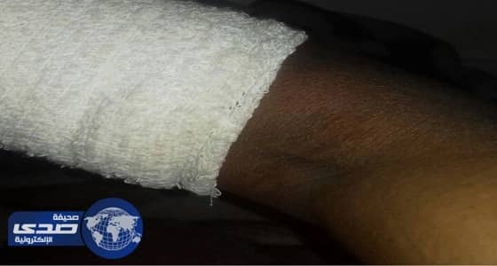 انقاذ ذراع مقيم من البتر بمستشفى الحناكية