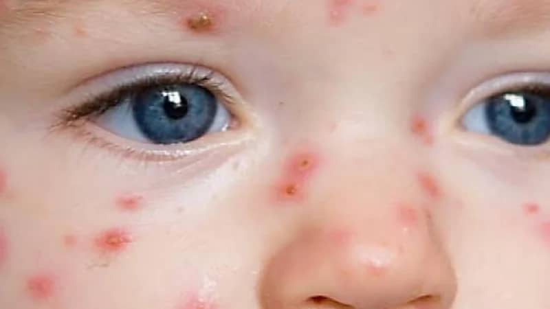 أسباب وأعراض مرض الشرى عند الأطفال