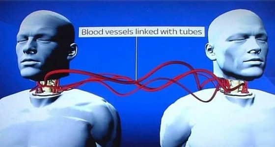 نجاح أول عملية زرع رأس على جسم إنسان